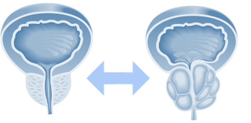 Cancer de la prostate